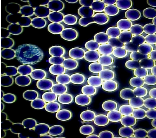Live Blood analysis before and after Hyperbaric Oxygen Therapy