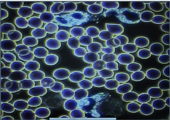 Live blood analysis after HBOT