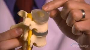 Stages of Spinal Degeneration